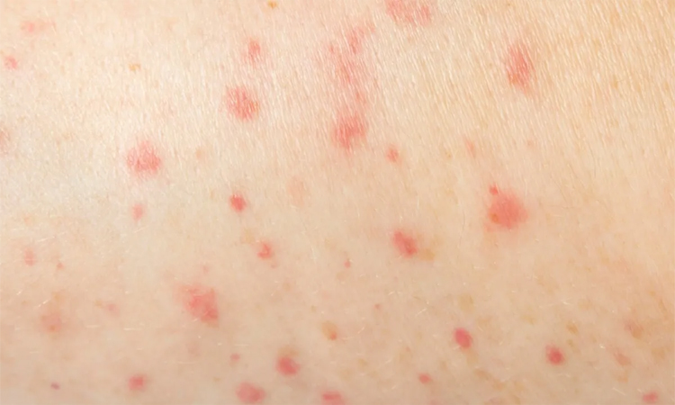 Chickenpox:చికెన్ పాక్స్ మళ్లీ కలకలం
