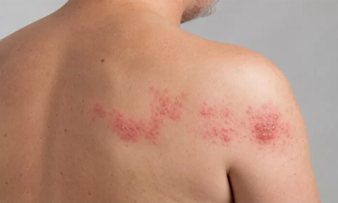 Shingles